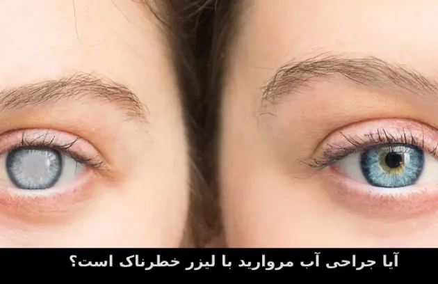 آیا جراحی آب مروارید با لیزر خطرناک است؟