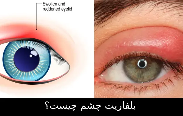 بلفاریت چشم چیست؟