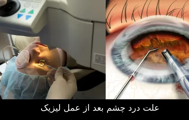 علت درد چشم بعد از عمل لیزیک