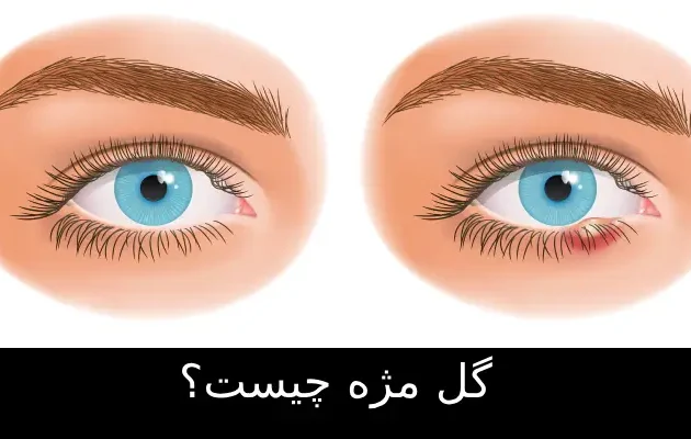 گل مژه چیست؟