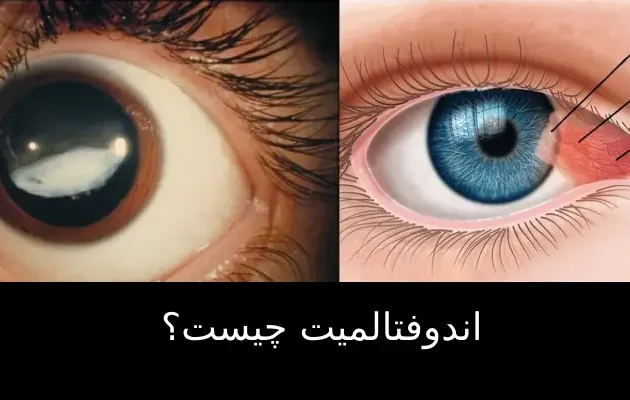 اندوفتالمیت چیست؟