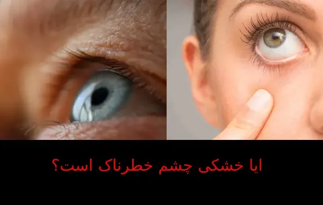 ایا خشکی چشم خطرناک است؟