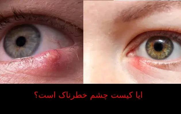 ایا کیست چشم خطرناک است؟
