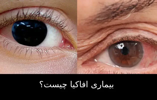 بیماری افاکیا چیست؟