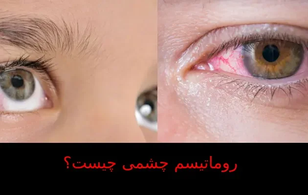 روماتیسم چشمی چیست؟