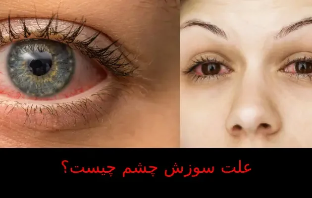 علت سوزش چشم