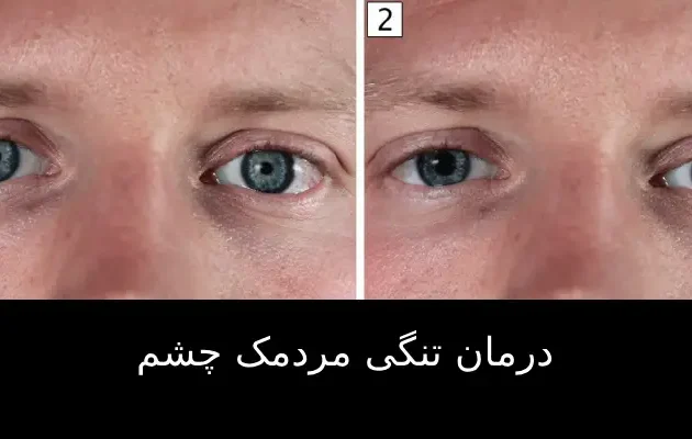 درمان تنگی مردمک چشم