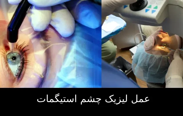 عمل لیزیک چشم استیگمات