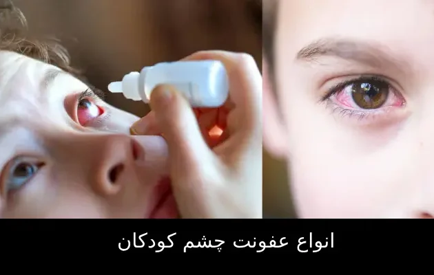 عفونت چشم کودکان