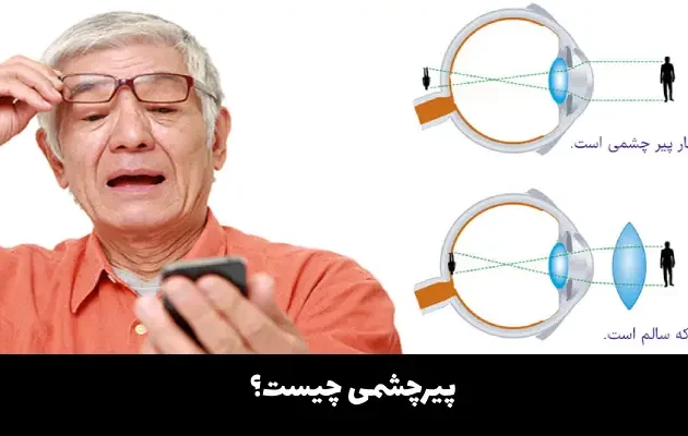 پیرچشمی چیست؟