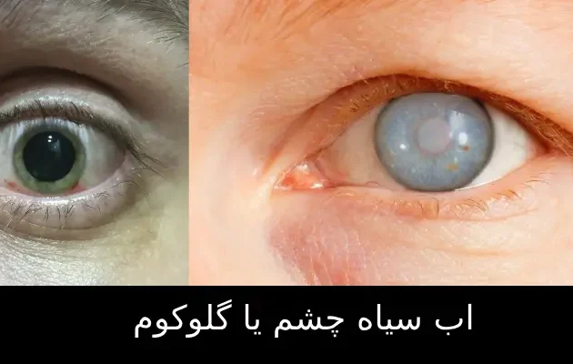 اب سیاه چشم یا گلوکوم
