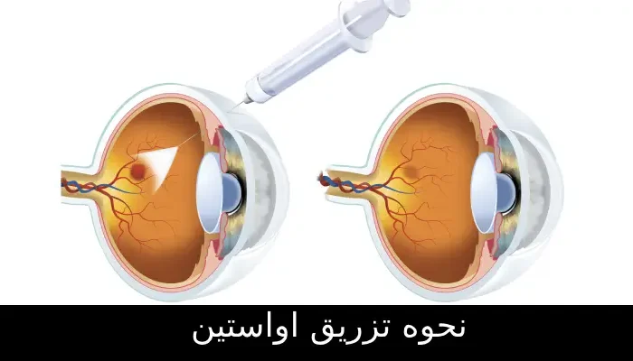تزریق اواستین