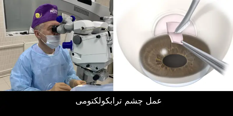 عمل چشم ترابکولکتومی