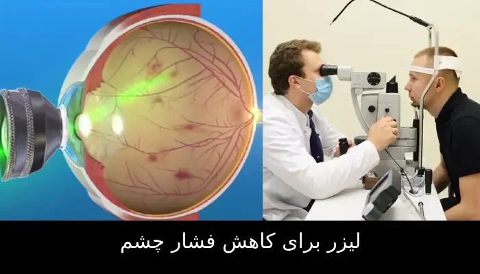 درمان لیزری فشار چشم