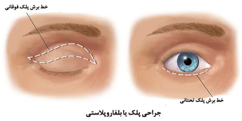 آیا عمل پلک برگشت دارد؟
