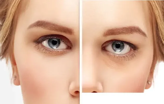 بهترین سن برای عمل بلفاروپلاستی چه سنی است؟