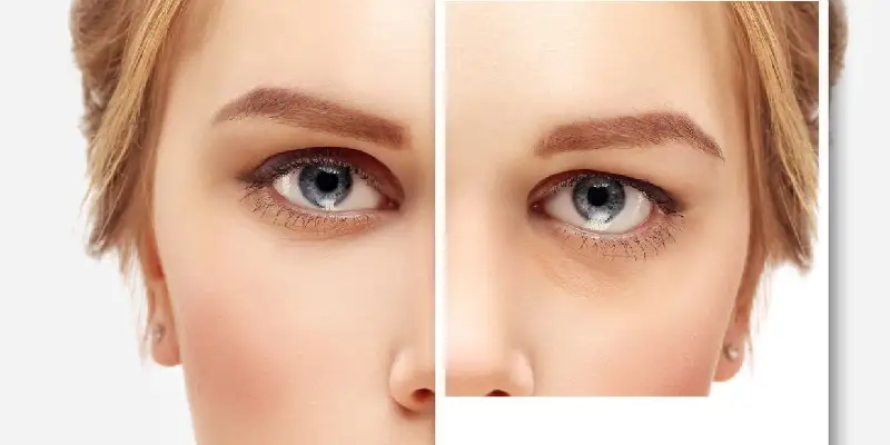 بهترین سن برای عمل بلفاروپلاستی چه سنی است؟
