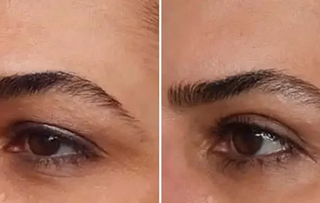 تجربیات واقعی از بلفاروپلاستی