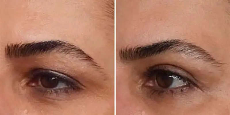 تجربیات واقعی از بلفاروپلاستی