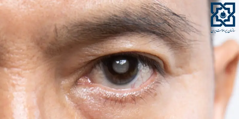 عمل اب مروارید با بیمه سلامت