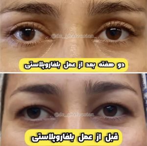 عمل بلفاروپلاستی